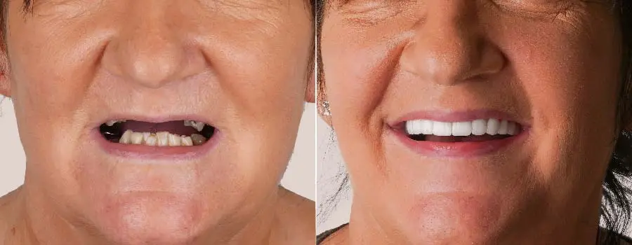 Full-mouth-dental-reconstruction-pic-2.webp