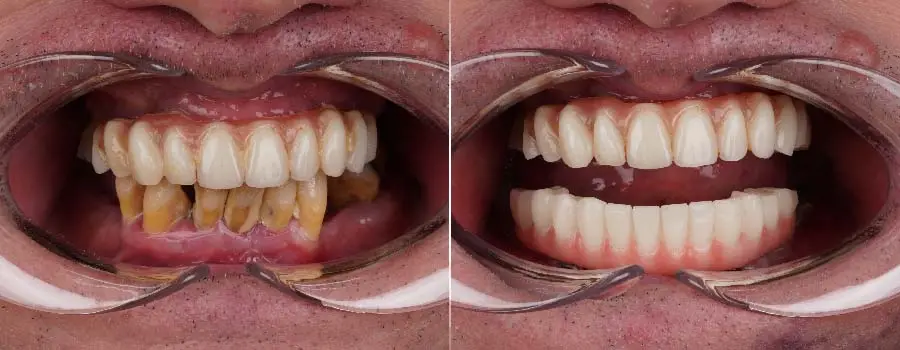 Grant-Lakey-got-his-teeth-done-at-Dentakay.webp