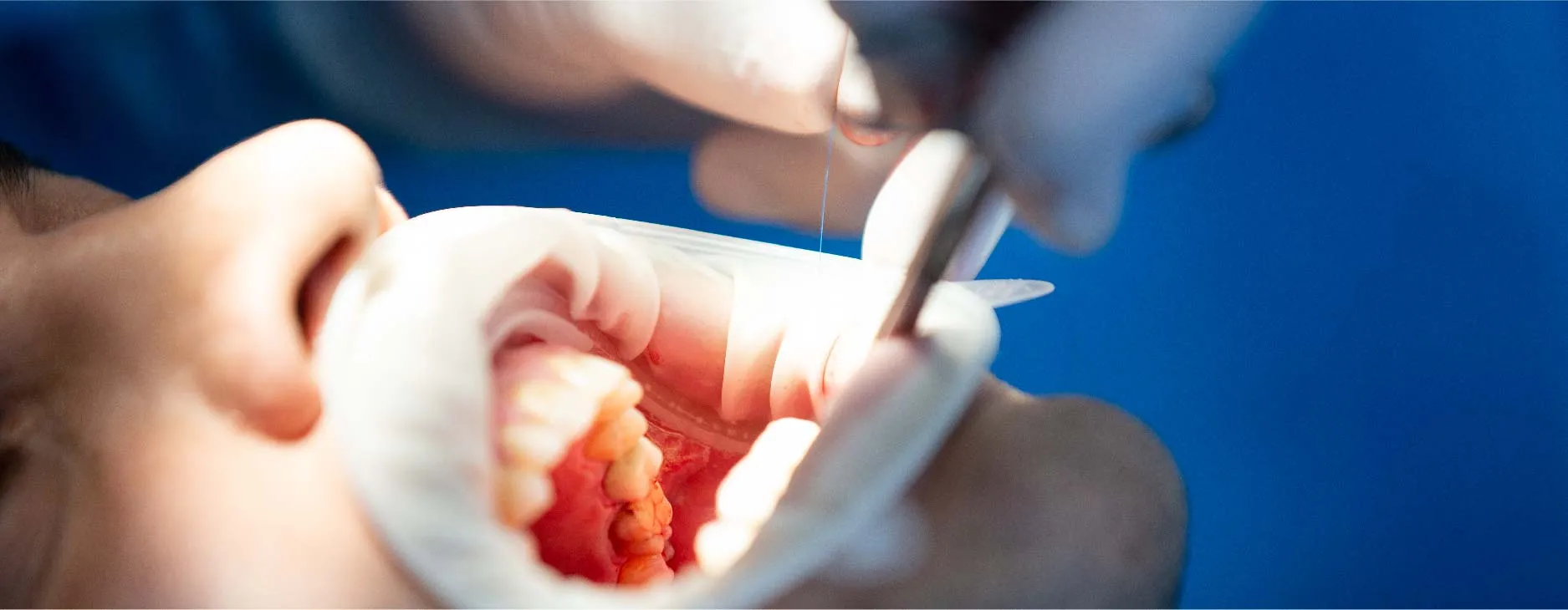 Healing-of-the-Surgical-Site.webp