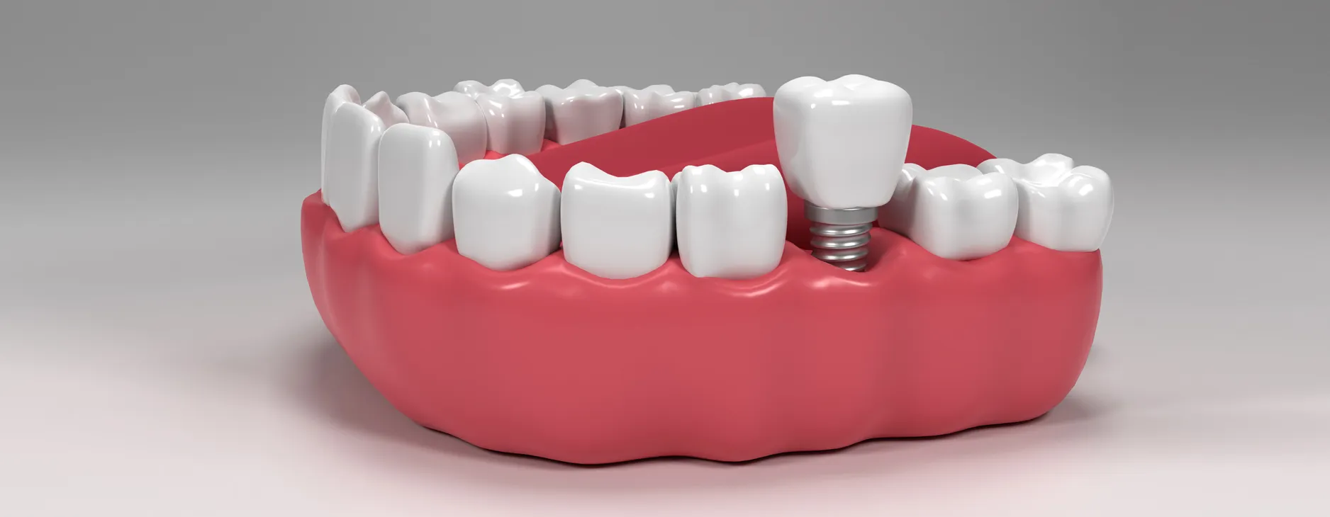 How-Long-Does-a-Dental-Implant-Take.webp
