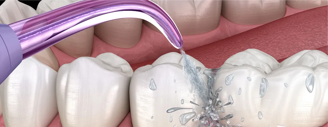 How-to-use-a-water-flosser.webp