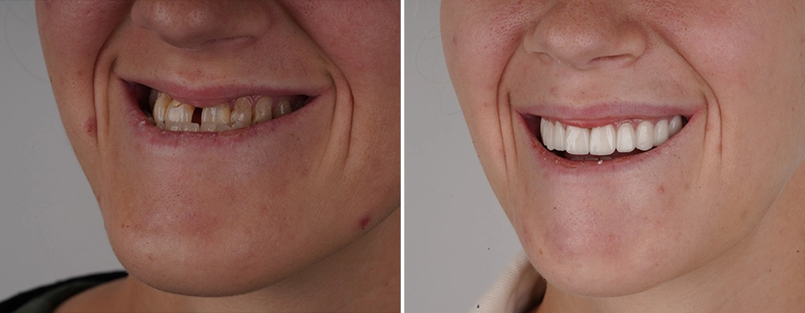 Jaw-correction-surgery-.webp