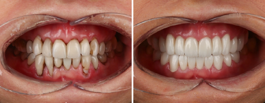Close-up of Liz Jones' zirconia crowns after treatment