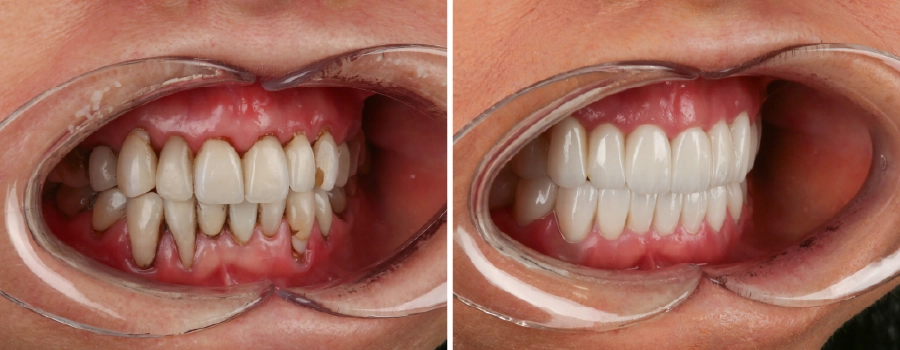 Liz Jones before and after zirconia crown treatment at Dentakay