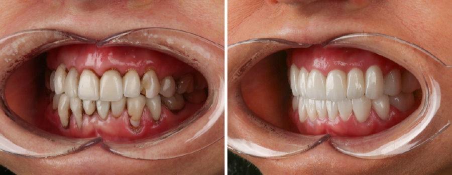 Liz Jones smiling after 22 zirconia crowns at Dentakay Istanbul