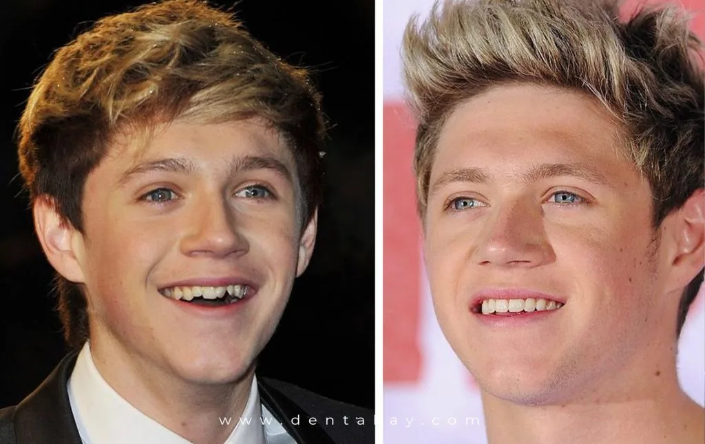 NialHoranveneers-1024x645.webp