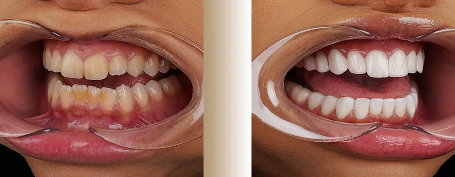What-is-a-dental-crown.webp