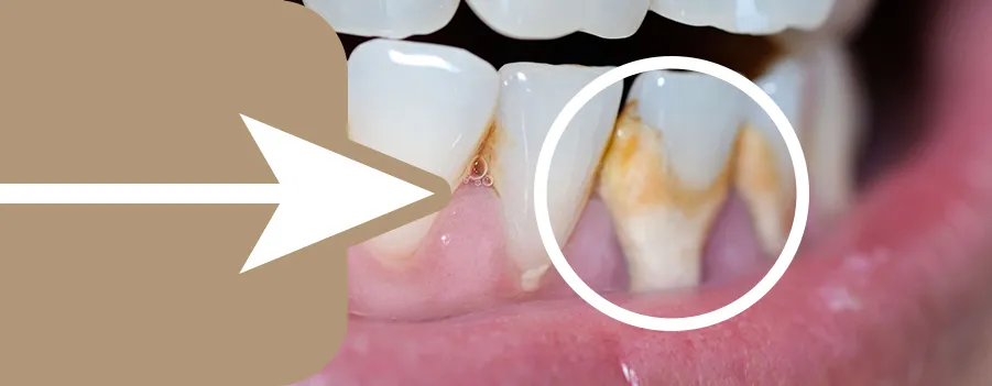 What-is-tartar-or-dental-calculus.webp
