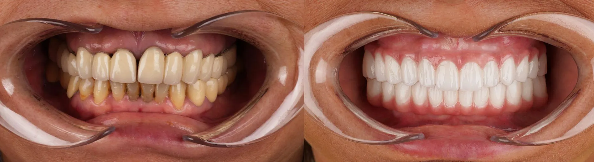 Yellow-teeth-before-after-.webp