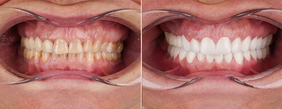 Zirconia crowns before after at Dentakay