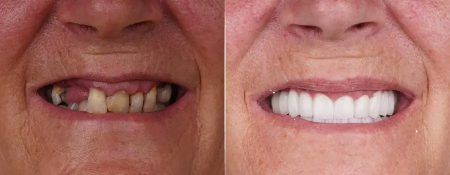 before-and-after-_Crunchy-and-Hard-Foods.webp