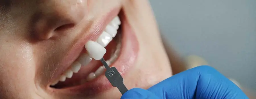 blog-_What-are-Dental-Veneers-.webp