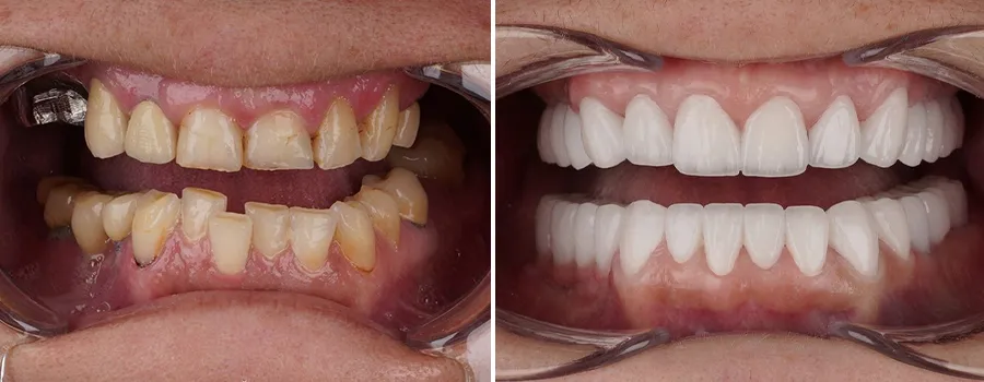 crooked-teeth-treatment.webp