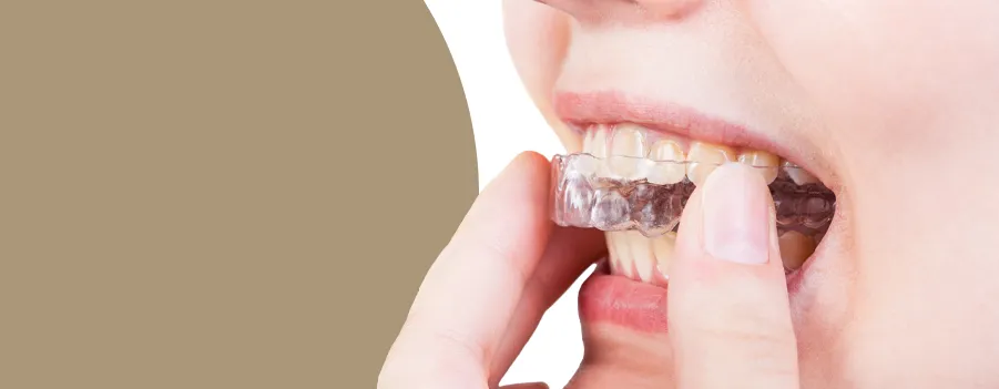 place-the-mouthguard-in-your-mouth.webp