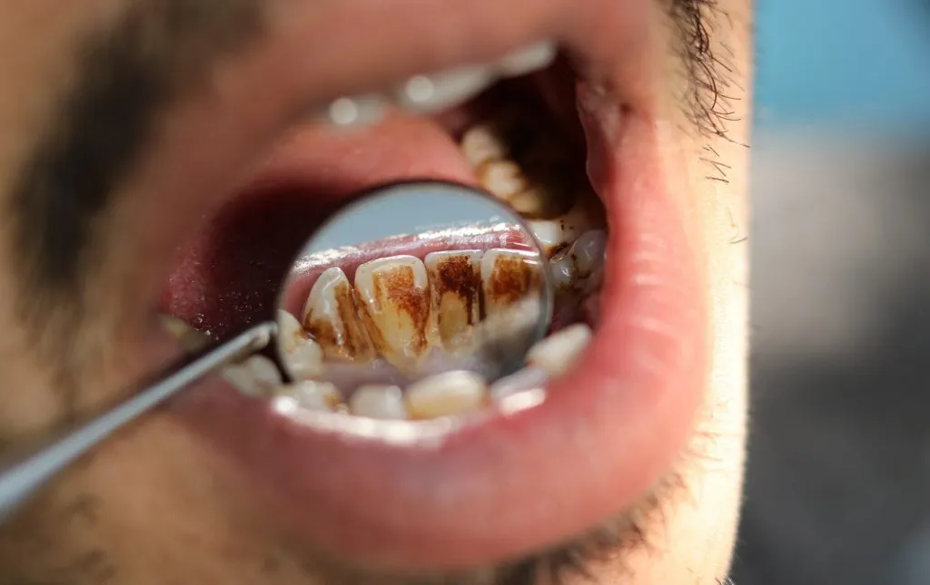 removingtobaccostains-1024x645.webp