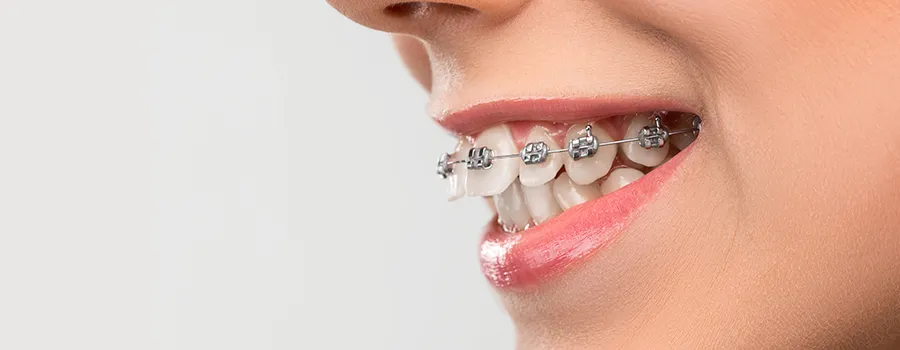 Smiling person with braces showing straight teeth.