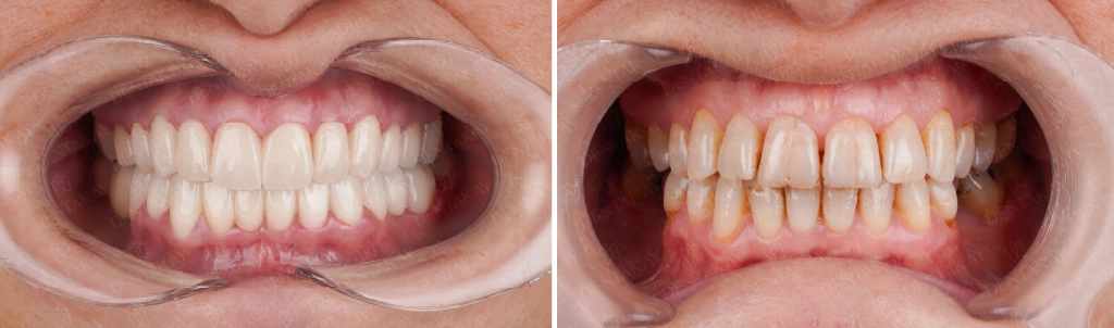 before after cracked teeth treatment at Dentakay