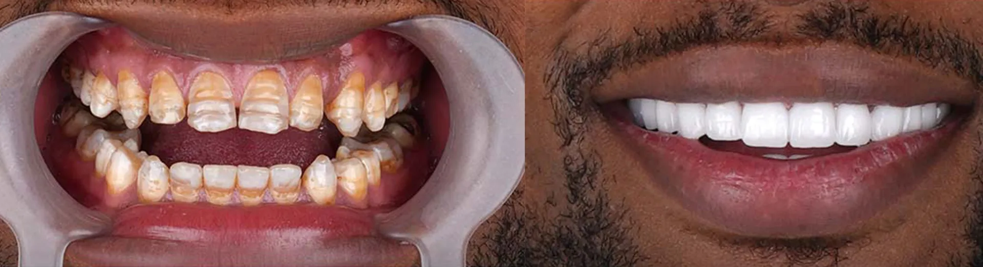 veneers-before-and-after-1.webp