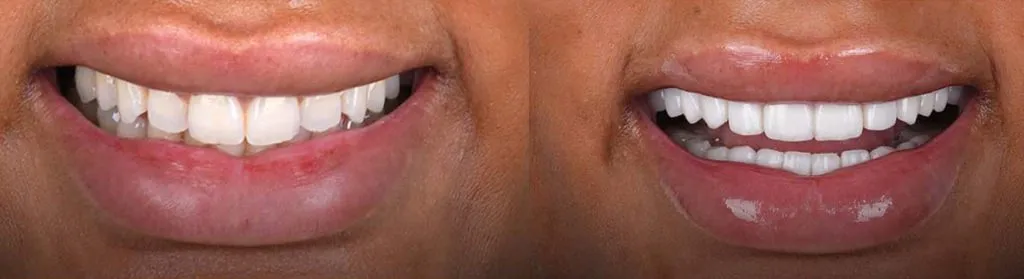 veneers-before-and-after-2-1024x279.webp