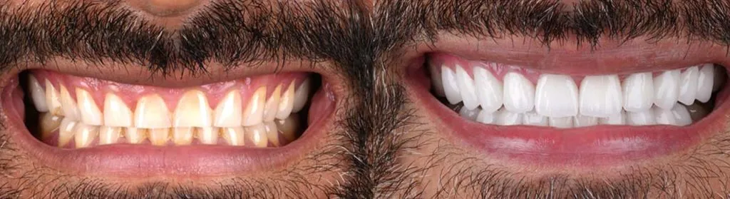 veneers-before-and-after-3-1024x279.webp