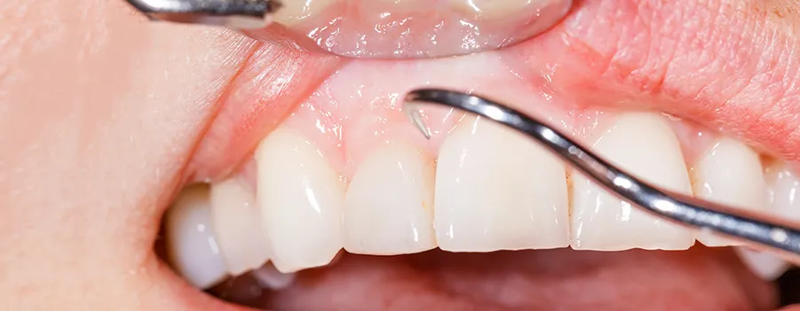 white-gums-symptoms-and-causes.webp