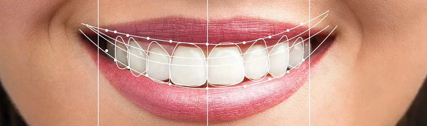 تصميم الابتسامة بكافة الخطوات والعمليات الهامة