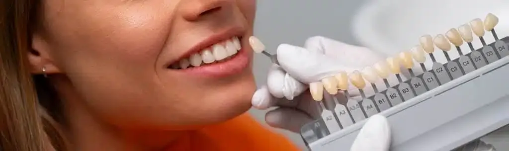 Adhesivo dental vs. carillas dentales
