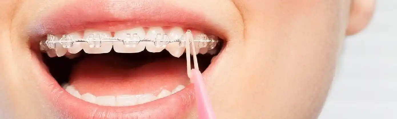 What is an Orthodontic Elastic? What is it Used for?