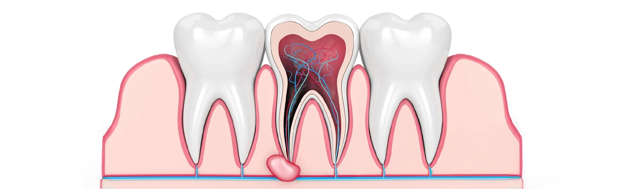 What is an Apicoectomy (Root-End Surgery)?
