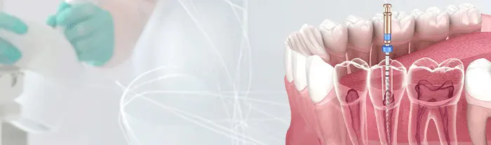 Root Canal Treatment for an Infected Tooth
