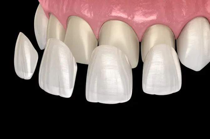 Veneers & Bonding