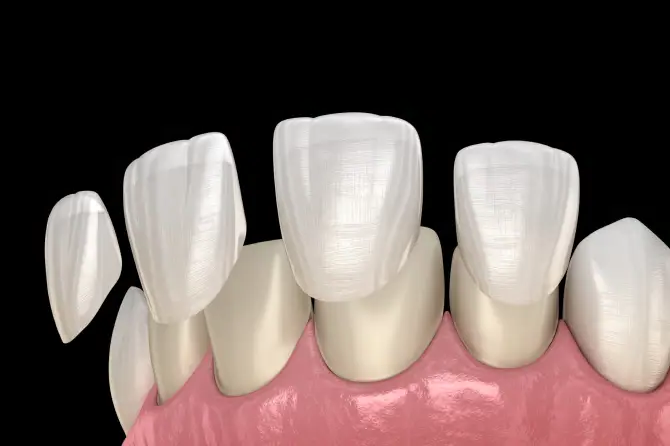 Precios de carillas dentales
