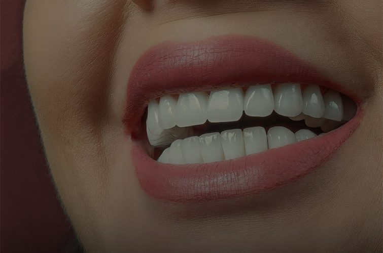Hollywood smile before and after photos