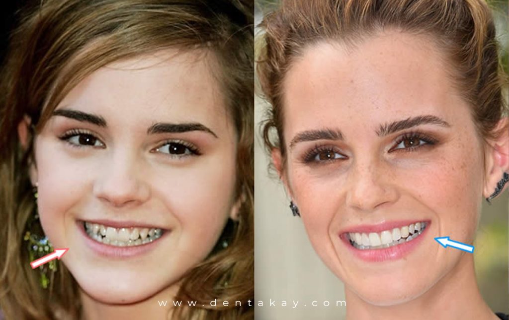 After fixing her severe alignment problems, Emma Watson got her veneers to get...
