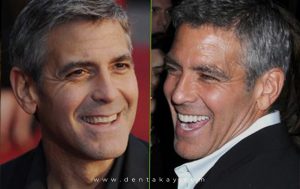 George Clooney before and after veneers