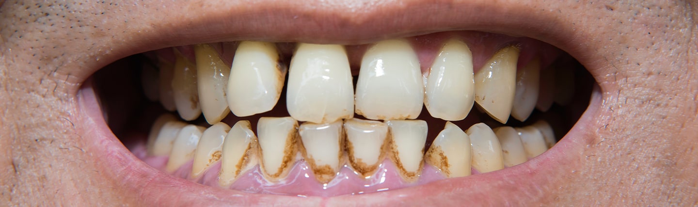 portátil para donar Pensativo Manchas en los dientes: 4 productos naturales para eliminarlas