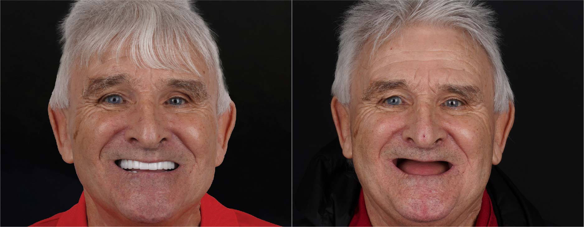 Antes y después de los implantes dentales All-on-4