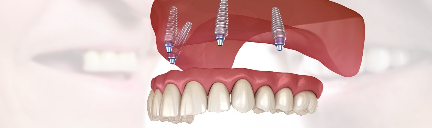prothèses dentaires fixes sur implants 