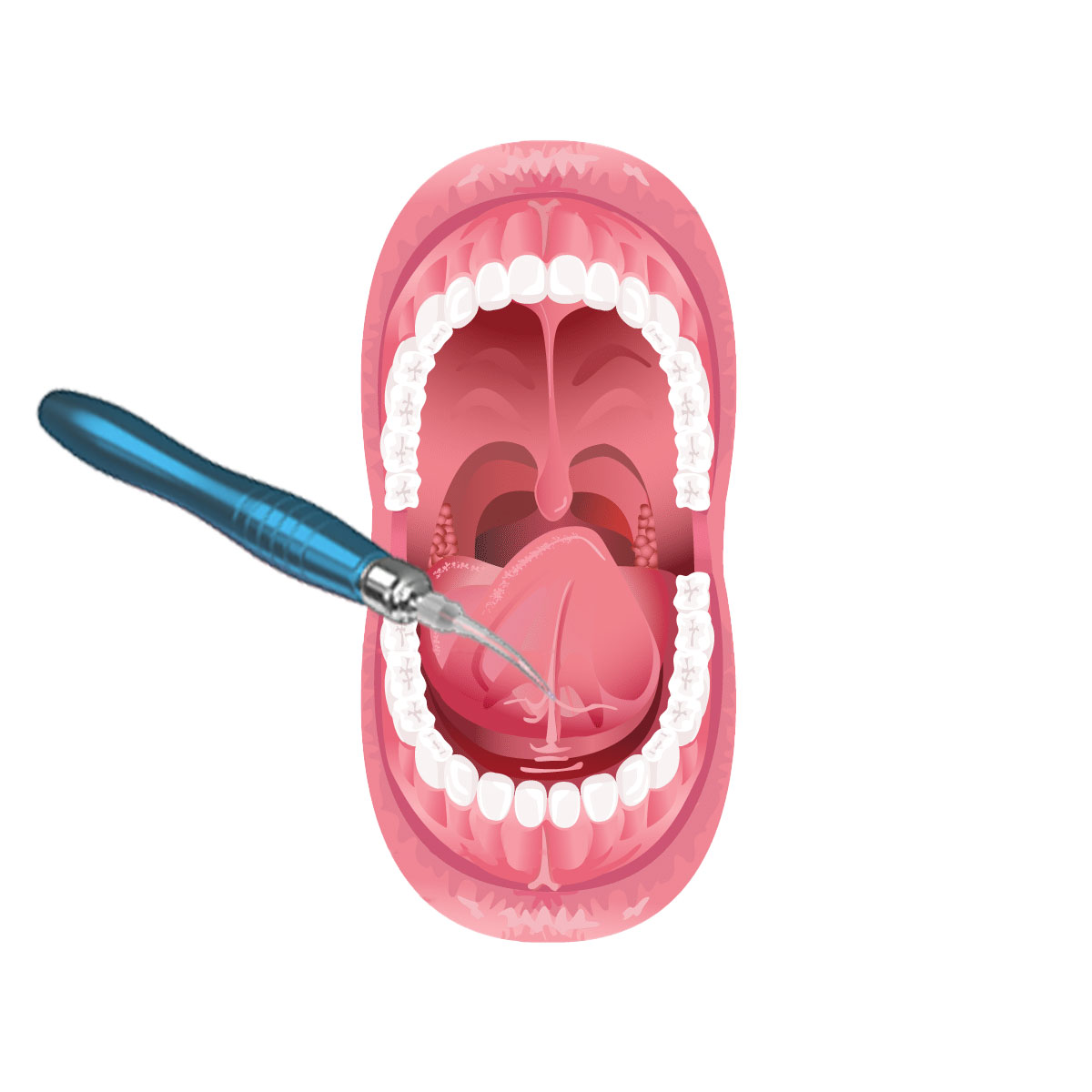 Tongue Frenectomy