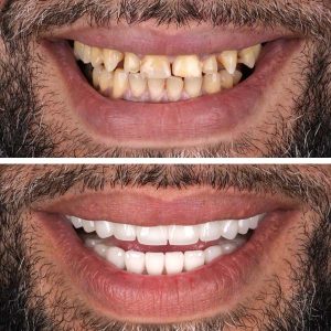 Hollywood Smile Before and After 5