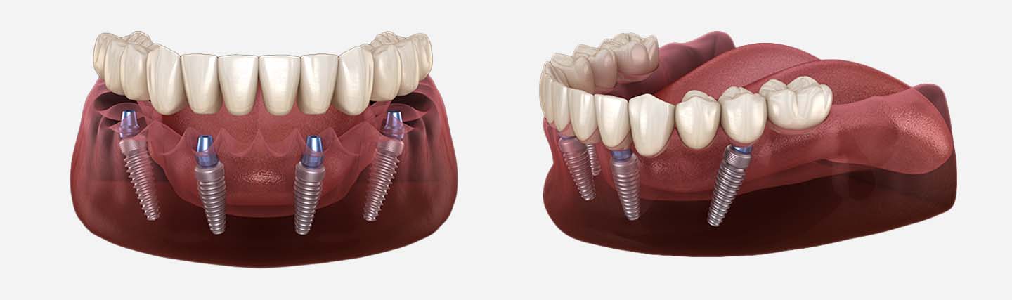 dentadura fija sobre 4 implantes precio