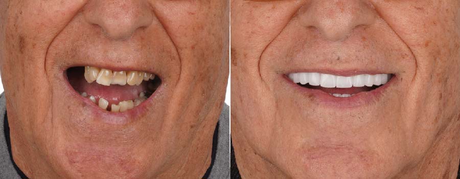 Dental implants before and after