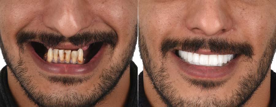 Dental implants Results