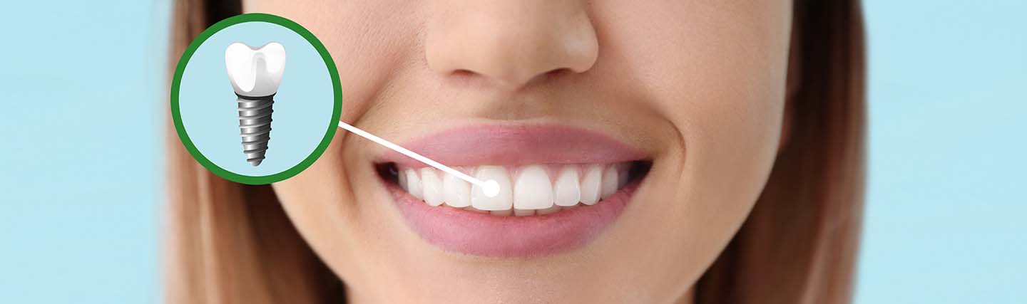 Prix des implants dentaires bouche complète