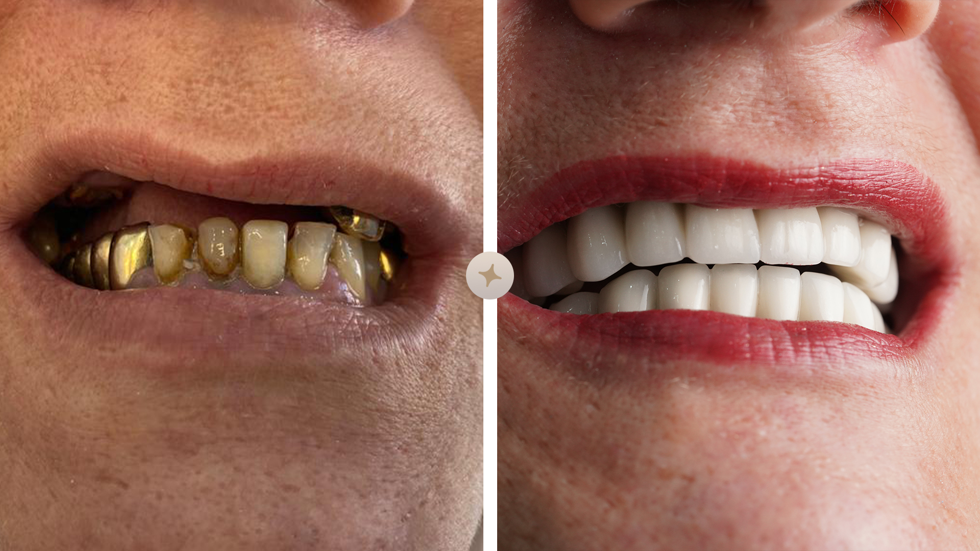 dental teeth before after pics