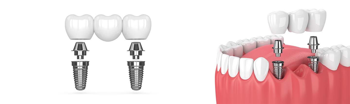 Puente dental o implante dental