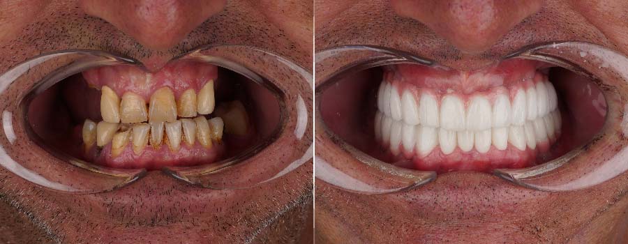 Dental implants Turkey- Dentakay