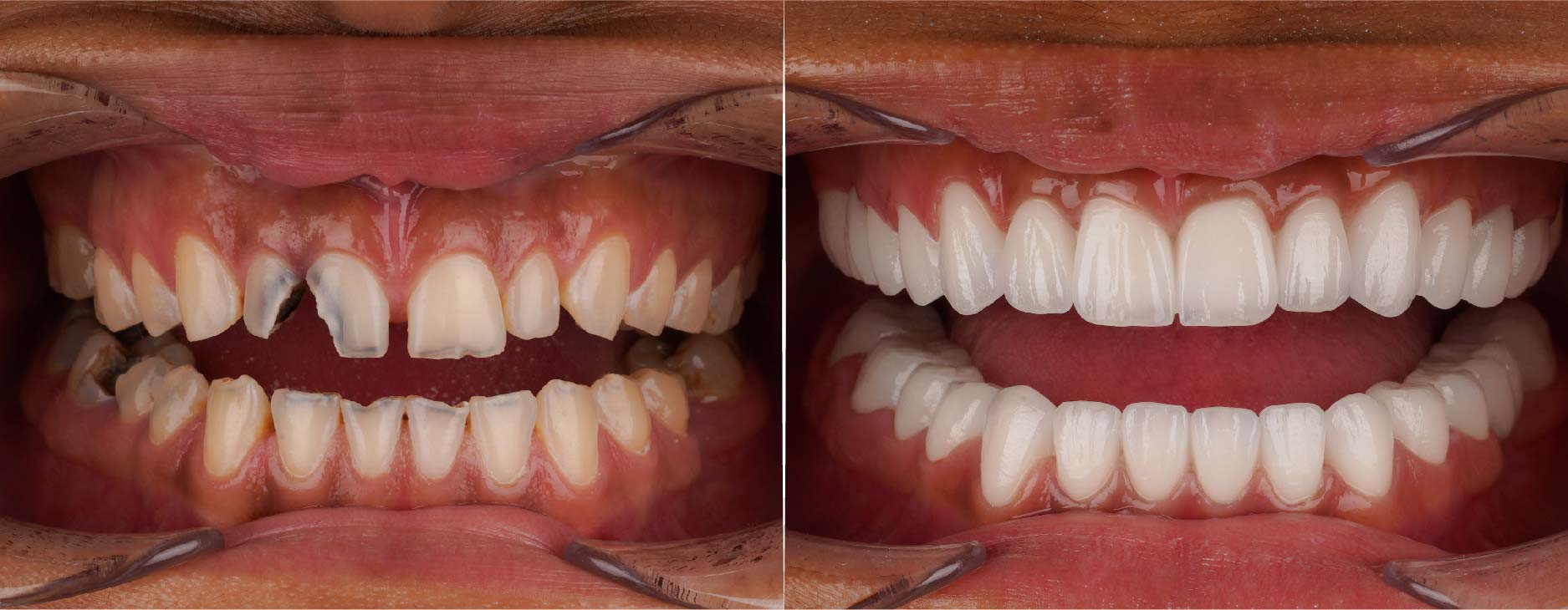 Chipped front teeth before after- Dentakay