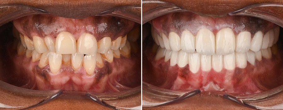 Crooked teeth treatment - Dentakay