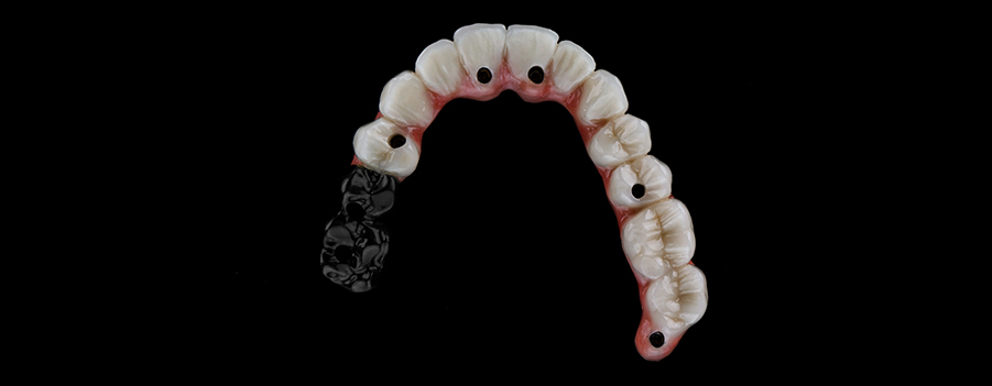 La quantité de tissu dentaire nécessaire à la pose d'une couronne varie selon le cas